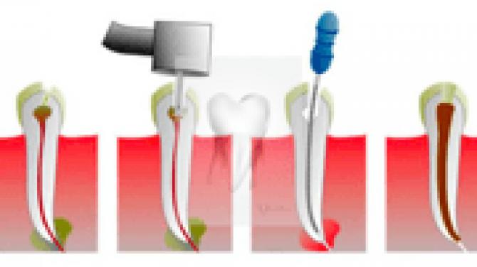 Зуб с непроходным каналом Склерозированные каналы зуба как лечить